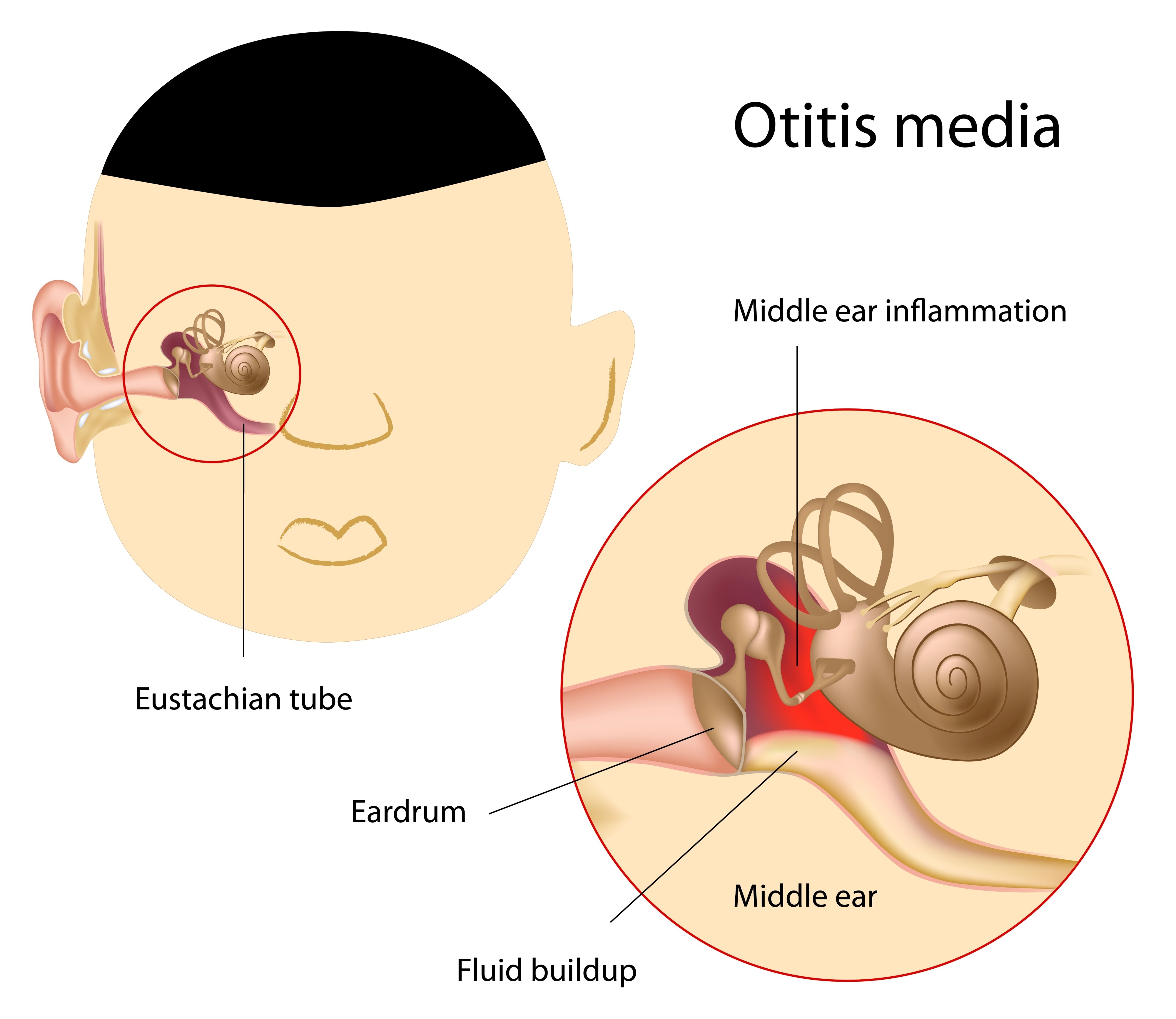 Otitis_Media_Middle_Ear_Infection_Shutterstock